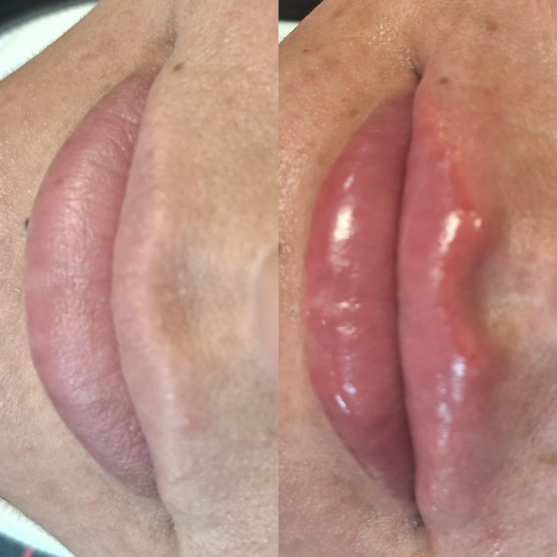 Antes e depois — Paciente 03, paciente da Gloss Beauty Clinic