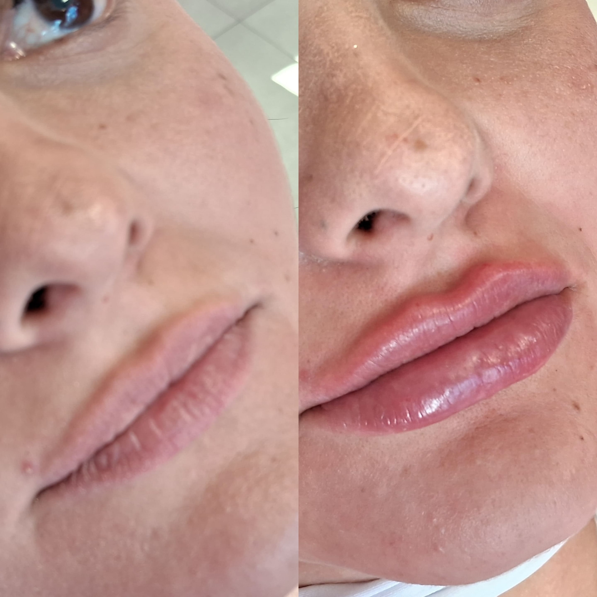 Antes e depois — Paciente 06, paciente da Gloss Beauty Clinic