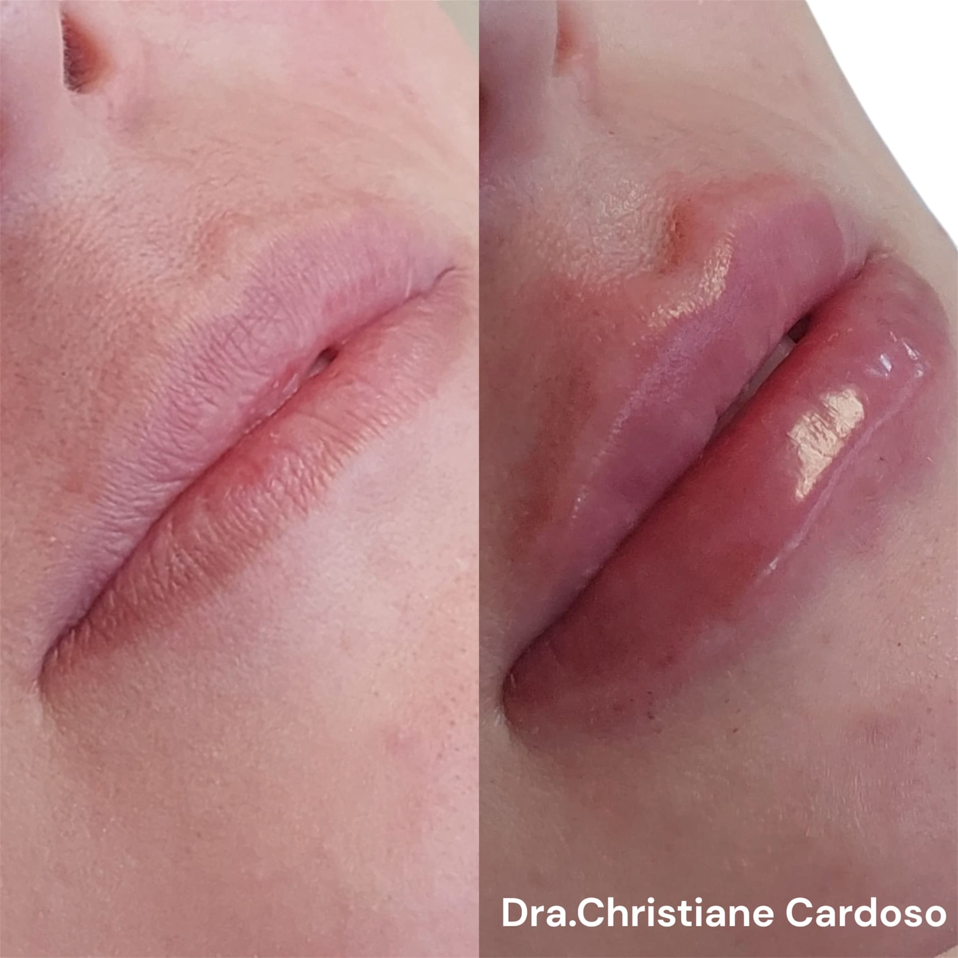 Antes e depois — Paciente 02, paciente da Gloss Beauty Clinic