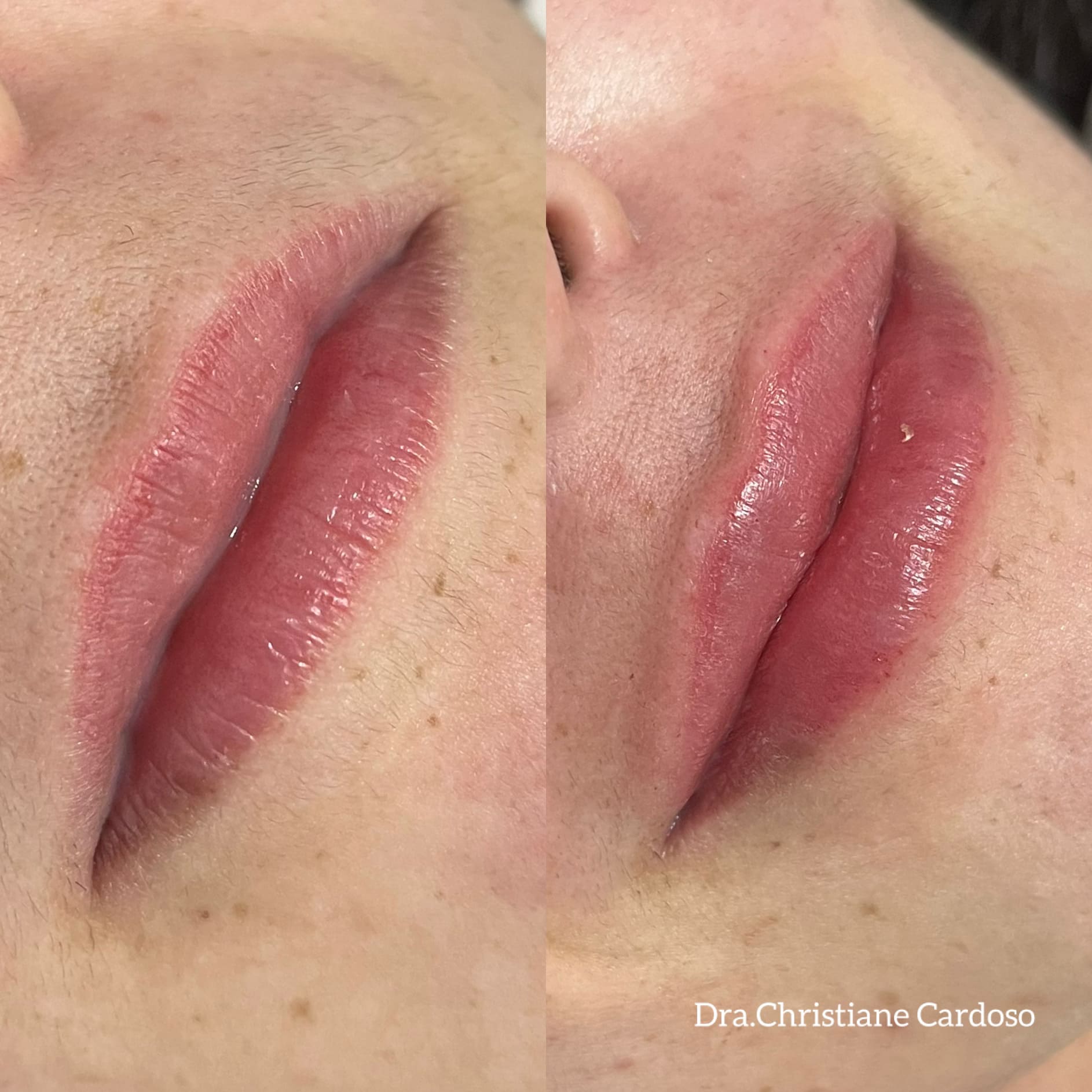 Antes e depois — Paciente 07, paciente da Gloss Beauty Clinic