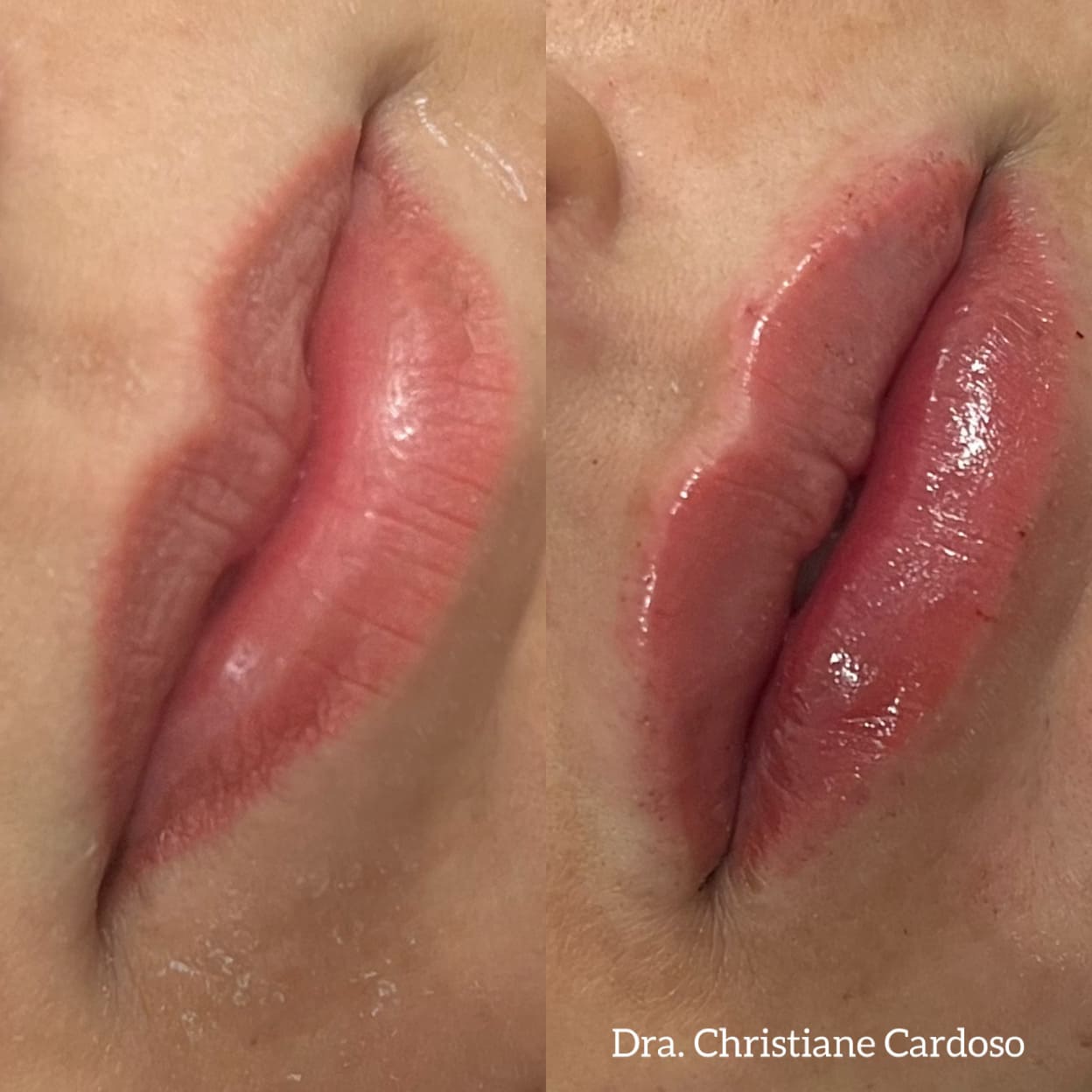 Antes e depois — Paciente 01, paciente da Gloss Beauty Clinic