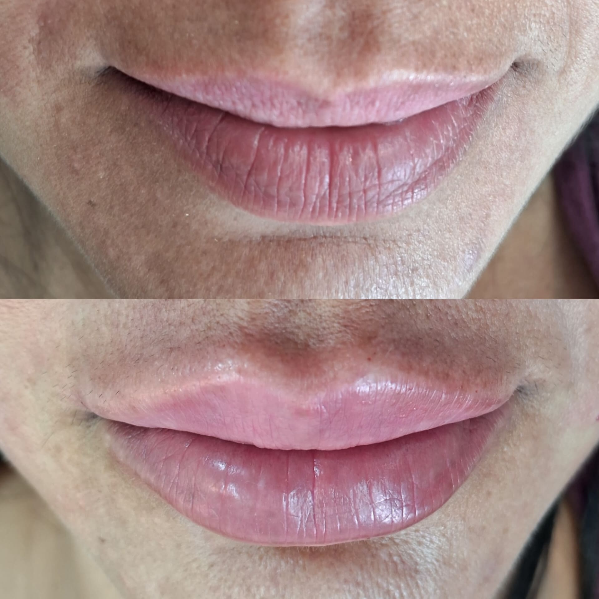 Antes e depois — Paciente 08, paciente da Gloss Beauty Clinic