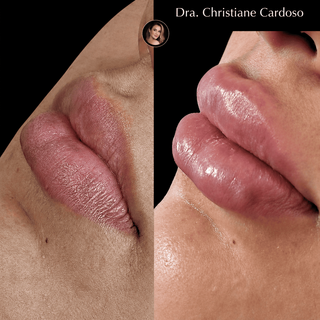 Antes e depois — Paciente 04, paciente da Gloss Beauty Clinic