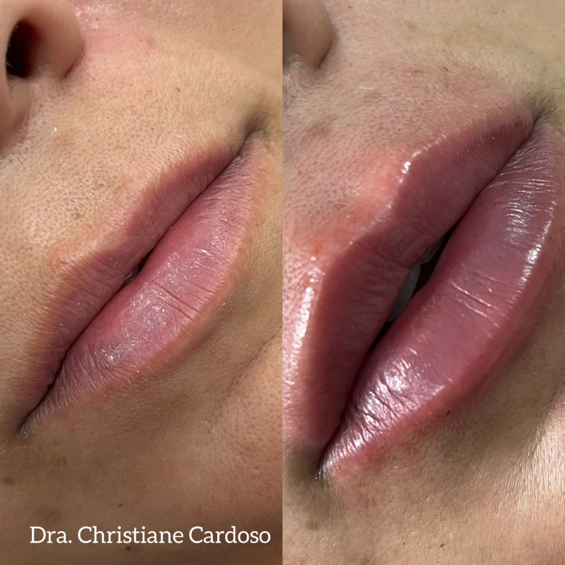 Antes e depois — Paciente 05, paciente da Gloss Beauty Clinic
